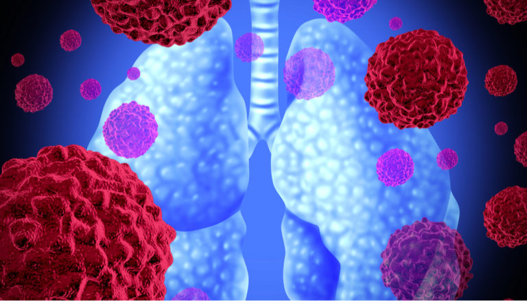 SCLC vs. NSCLC: What's the Difference? | NFCR Lung Cancer