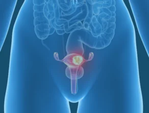 Uterine Cancer Location Uterine Cancer Location