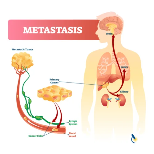 Metastasis Infographic Square Metastasis Infographic